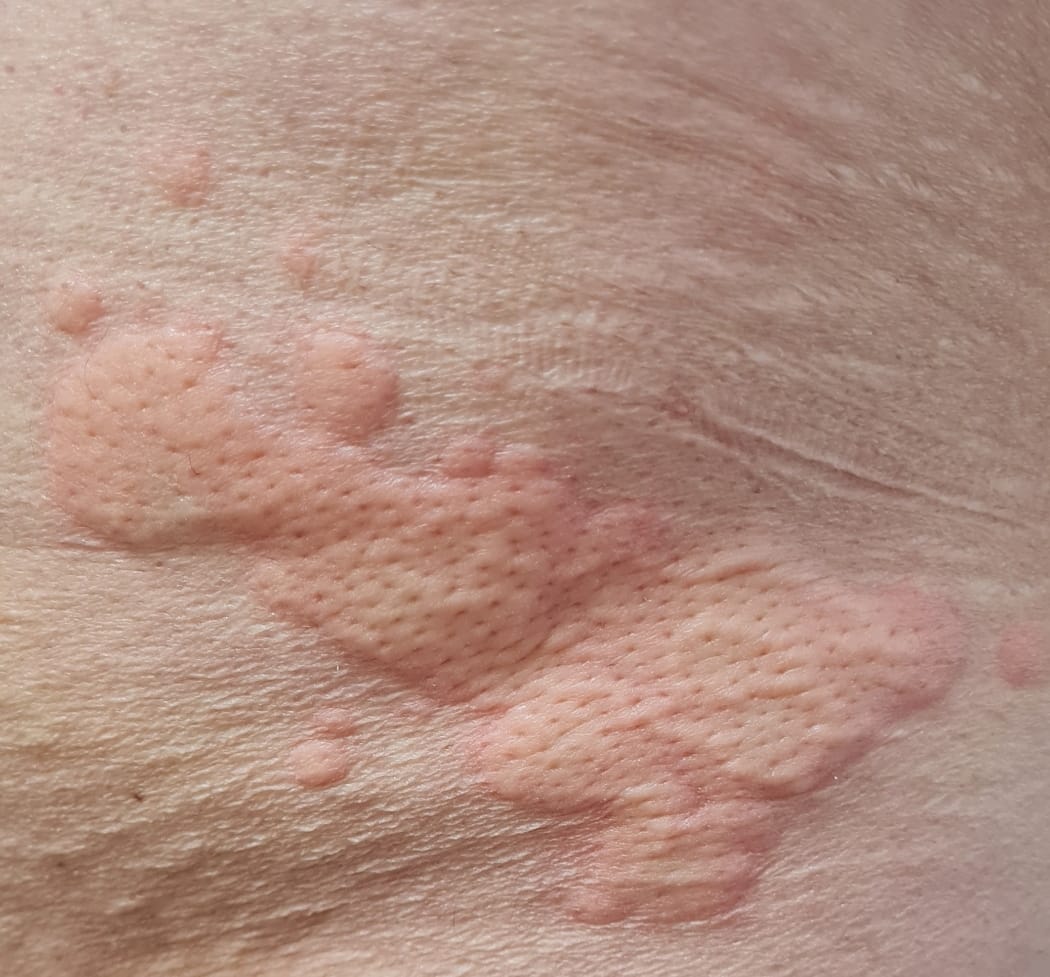 Urticaria