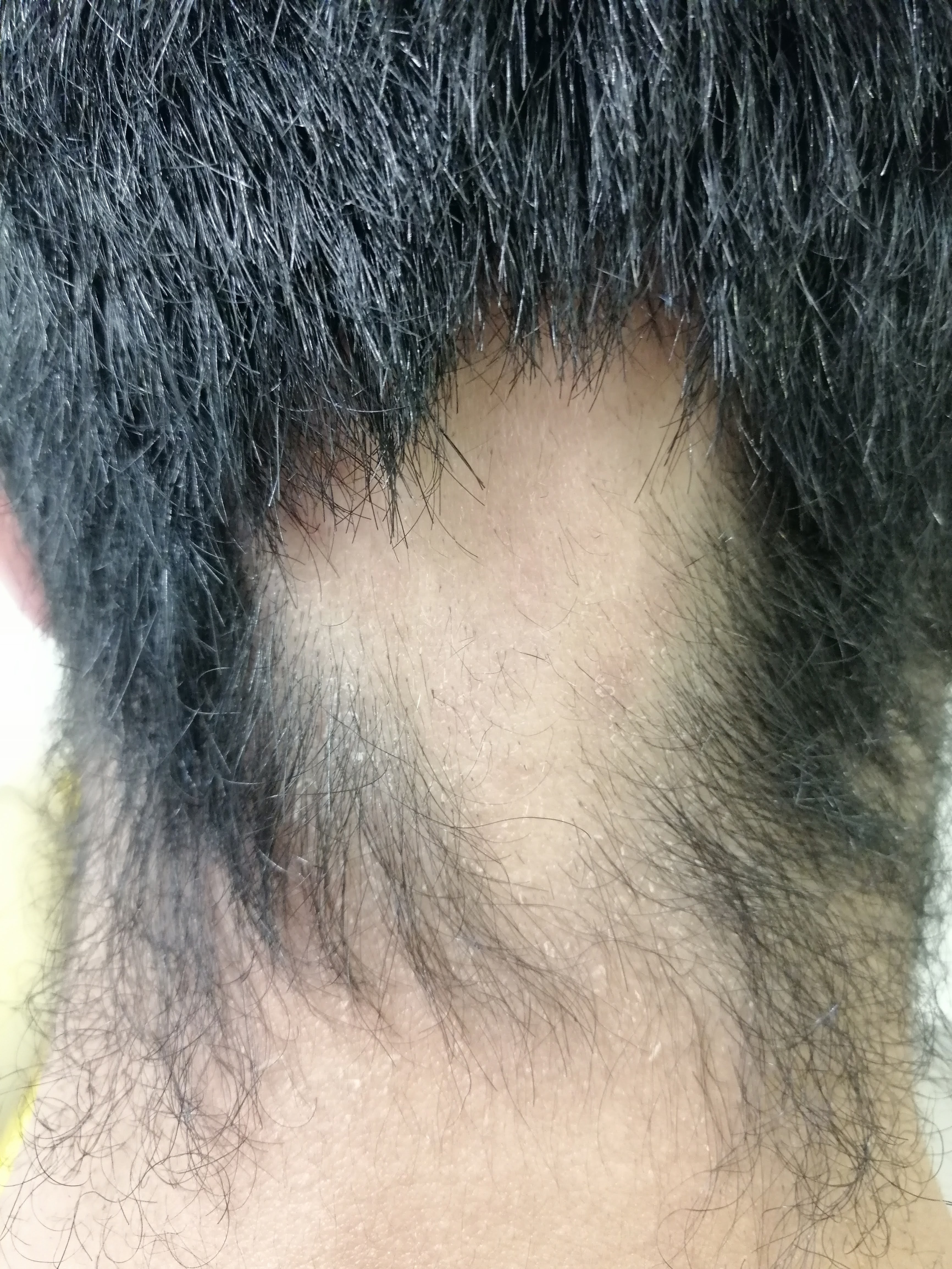 Alopecia Areata