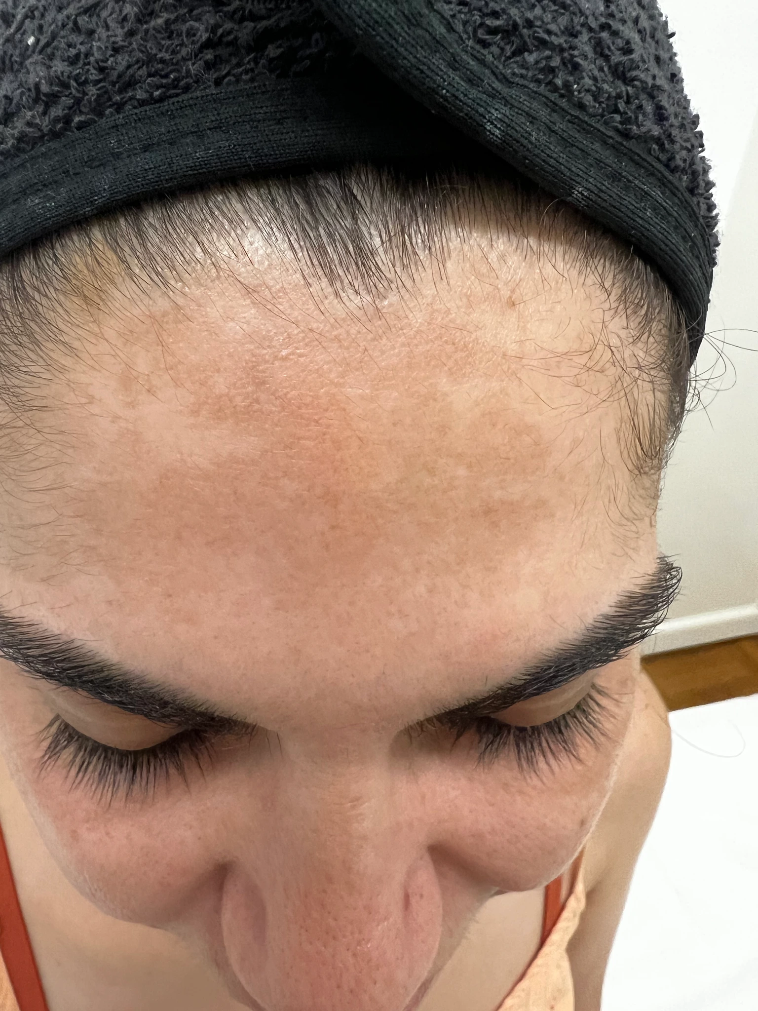 Melasma