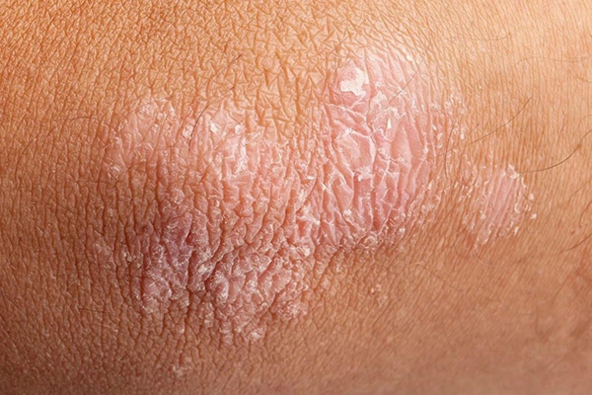 Psoriasis • Codo