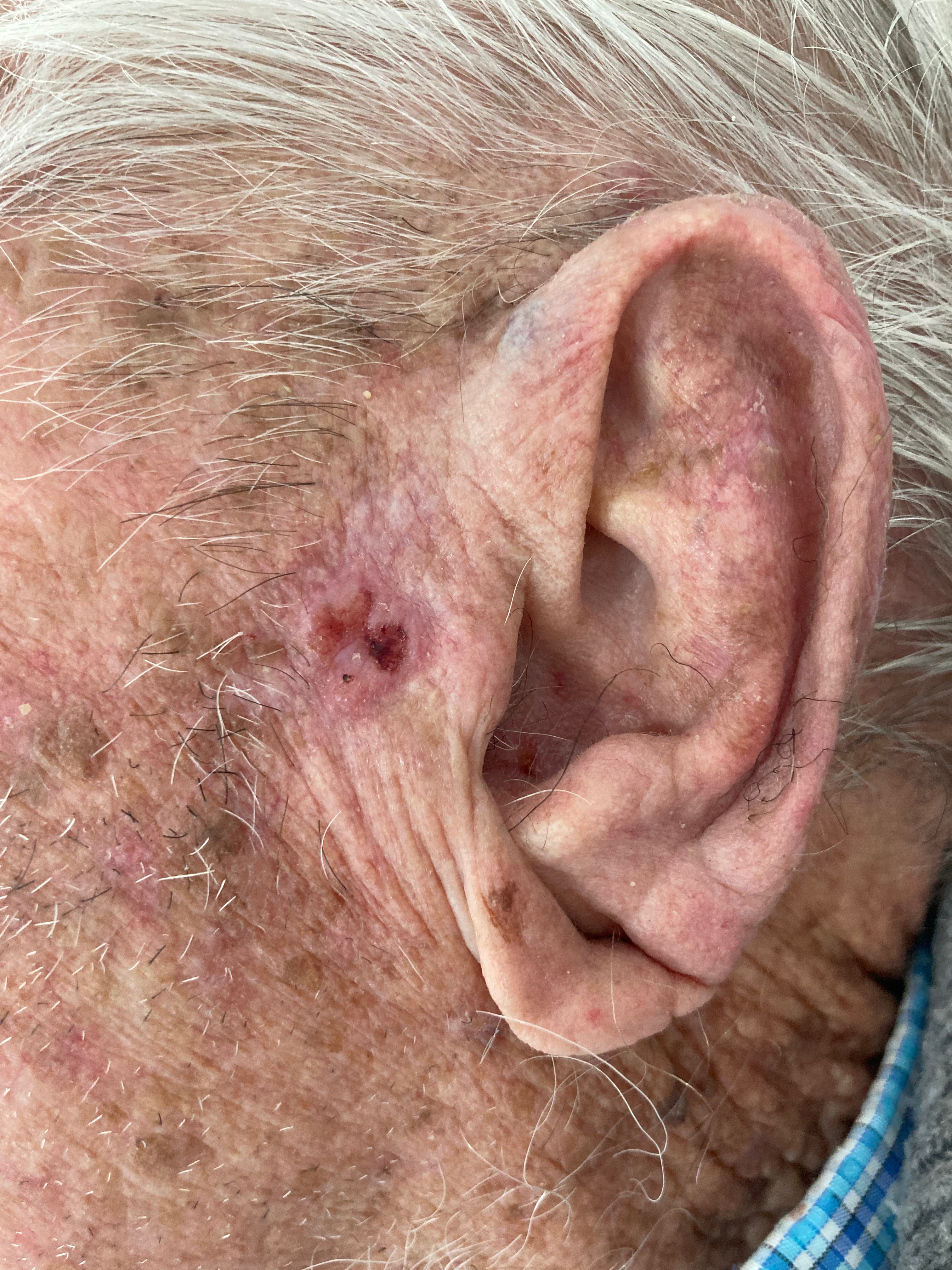 Carcinoma Basocelular (CBC)