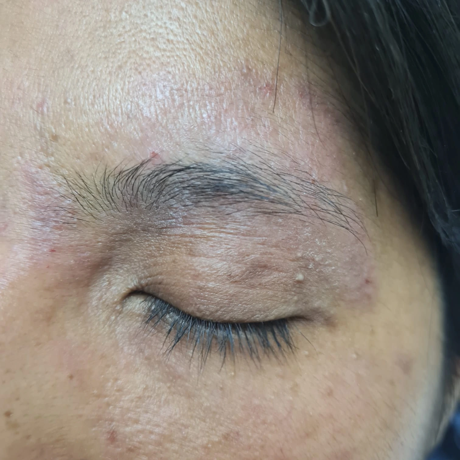 Dermatotis Atópica