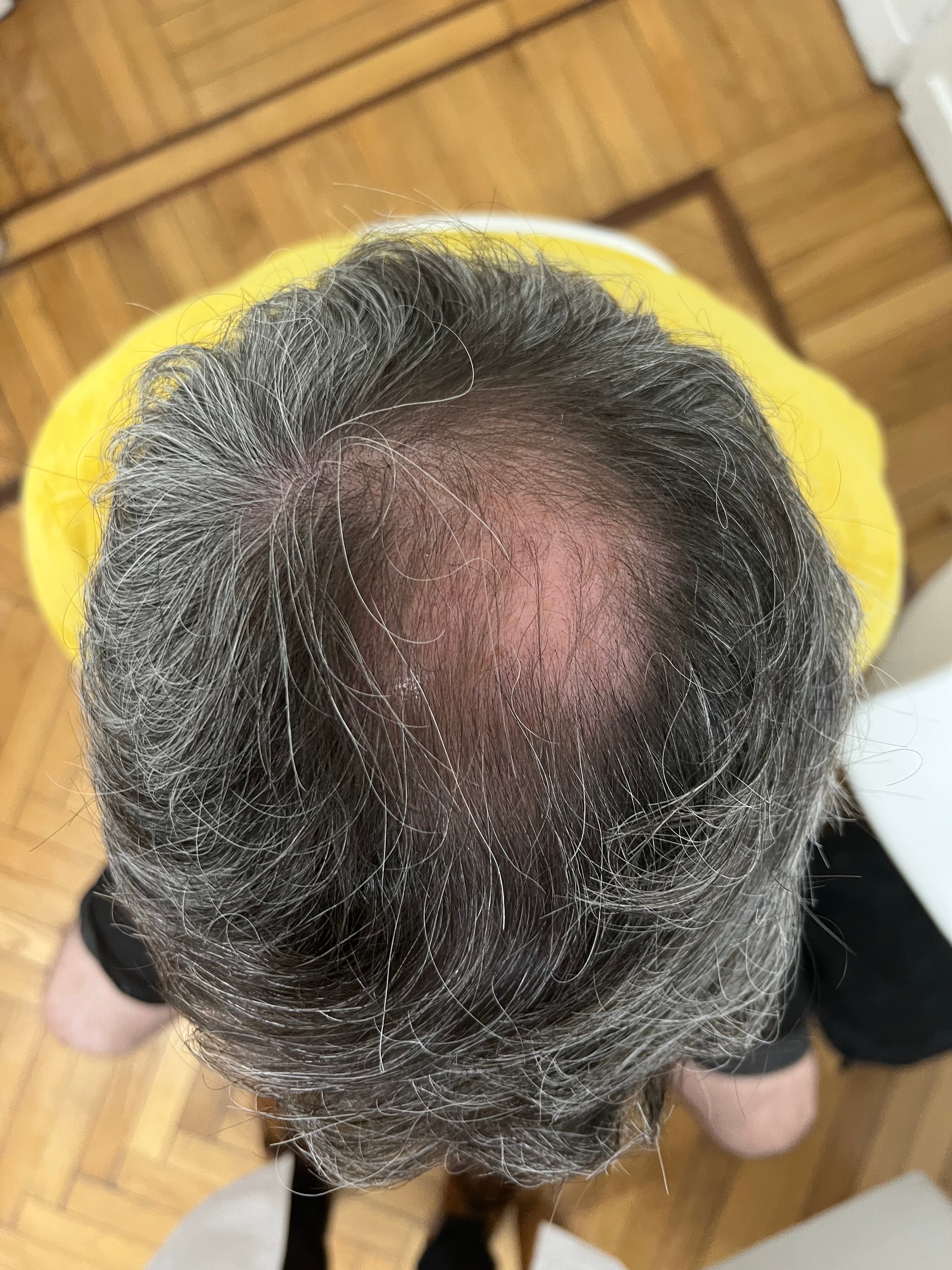 Alopecoa Androgenética • en tratamiento