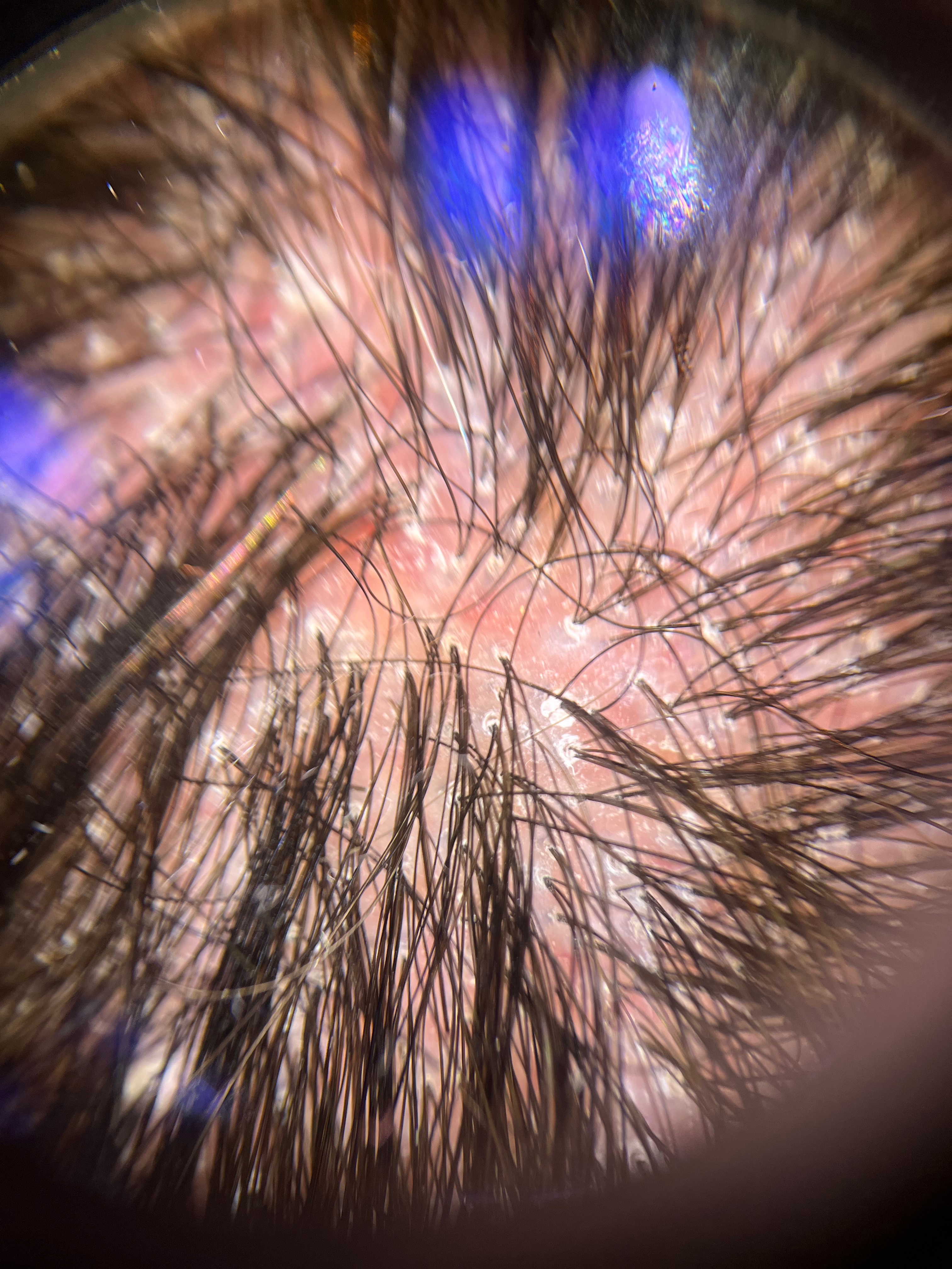 Liquen Pilar • Imagen tricoscópica