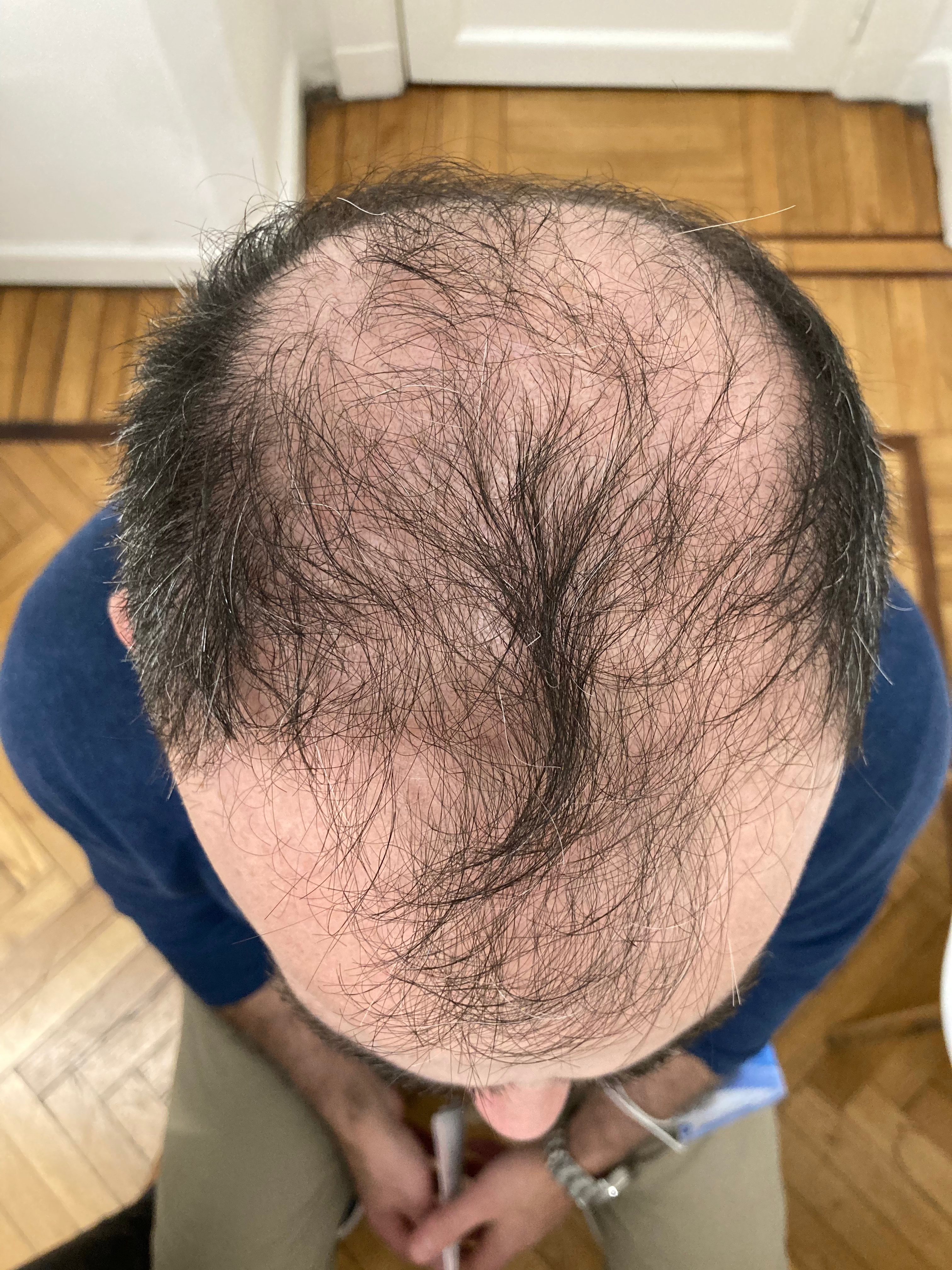 Alopecoa Androgenética
