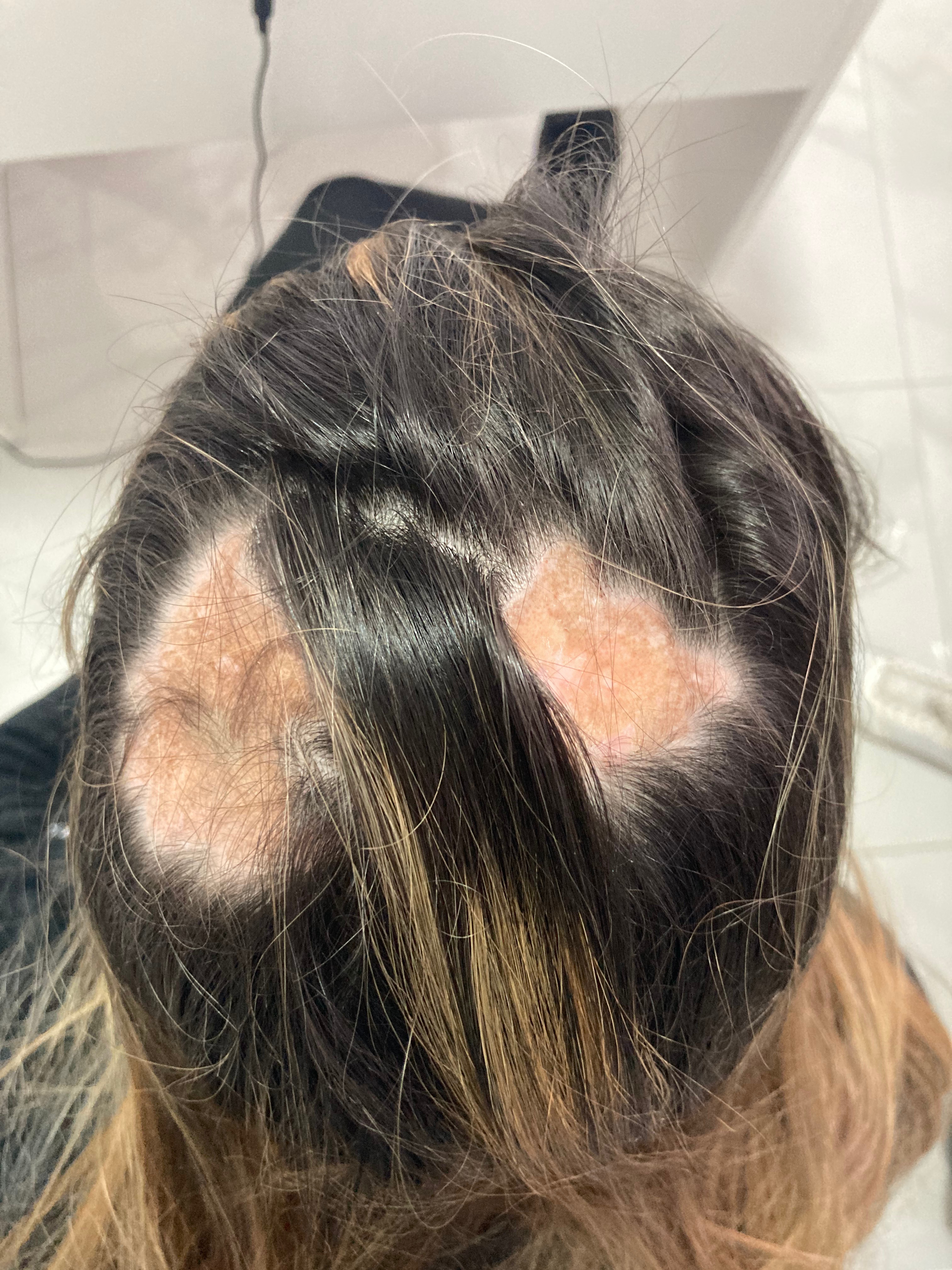 Lupus Discoide • Alopecia Cicatrizal