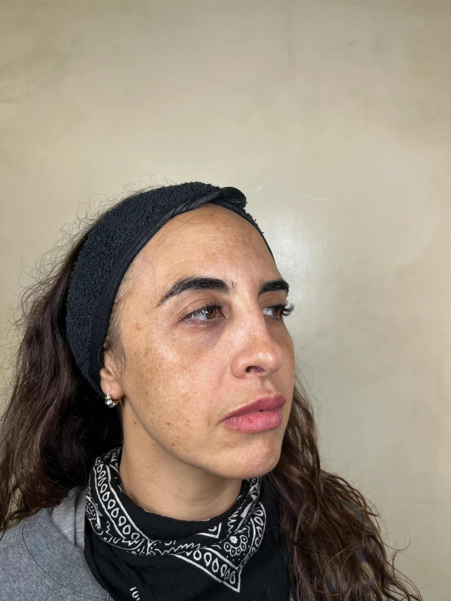 Melasma