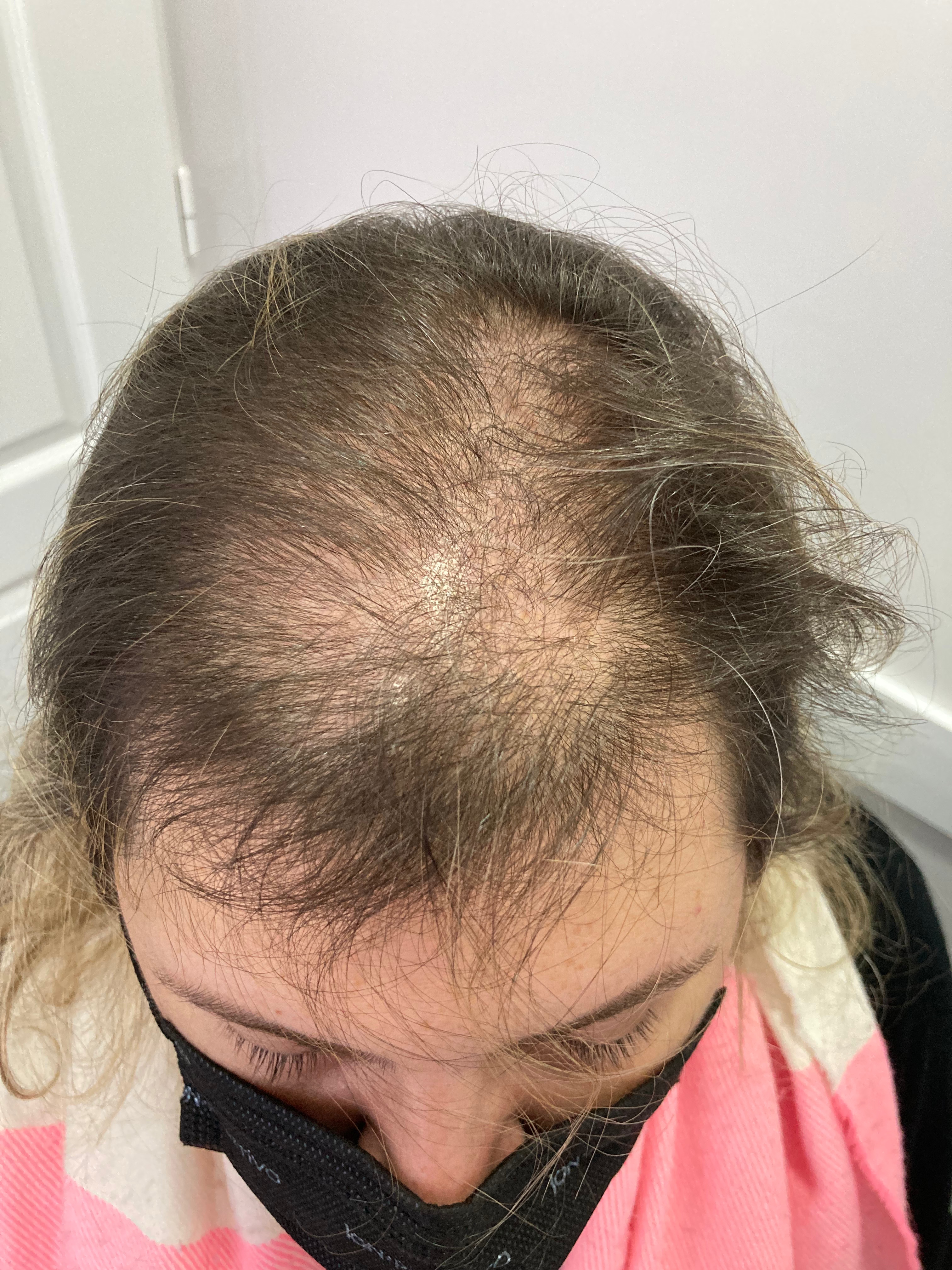 Alopecia Androgenética Femenina • Pérdida de cabello de patrón femenino (FPHL)